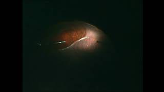 Retinectomy - Dr. Mayank Bansal