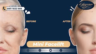 WAJAH AWET MUDA DENGAN TINDAKAN FACELIFT