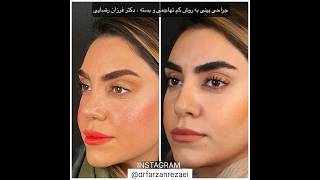 جراحی بینی طبیعی و شیک