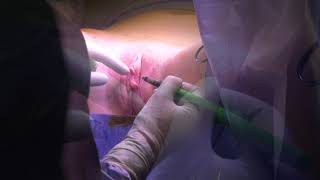 the procedure of Vulva surgical rejuvenation (only for professionnel)