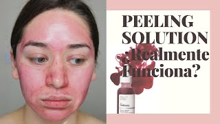 ¿EL PEELING SOLUTION TE ORDINARY FUNCIONA? O ES SOLO FAMA | PRIMERA VEZ USANDO UN EXFOLIANTE QUIMICO