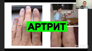 Лучший Метод Лечения Артрита |  Клинт Пэддисон