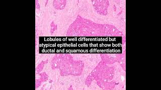 Histopathology of Squamoid Eccrine Ductal Carcinoma  #dermpath  #dermatopathology  #shorts