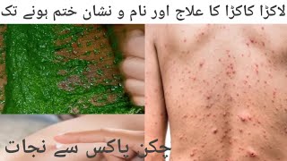 Chicken pox/Lakra kakra aur us ka illaj