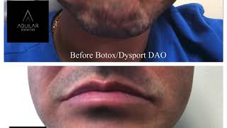 DAO Muscle with Botox - Dysport