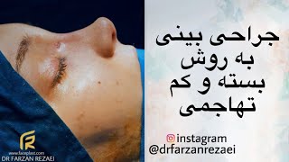 نمونه ای از جراحی بینی با انحراف تیغه ی بینی و نوک بینی‌ اُفتاده