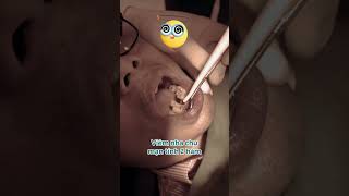 Nhổ răng dễ ợt #dental #nhakhoa #nhakhoahanseoul