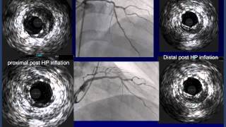 Imaging Matters: Identifying High risk Patients and Optimizing PCI