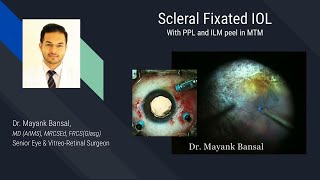 3 surgeries in 1? SFIOL Sutureless Glueless + MTM ILM Peel + PPL in Myopia Eye with Subluxated Lens