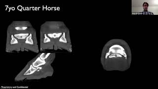 Navicular with Cyst Lesions