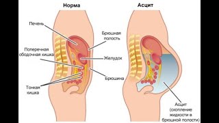 Куда ставить пиявки при асците живота?