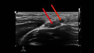 Pulsating arteries q 2