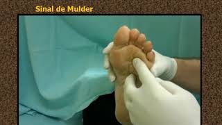 Hydrodissection of Morton's Neuroma guided by ultrasound.