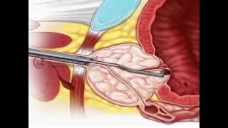 Ureteroscopy - Transurethral Resection of the Prostate (TURP) Dr. Ali Mehdi Zadeh Urologist