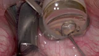 Goniosynechialysis (GSL) prior to Excisional Goniotomy with the Kahook Dual Blade