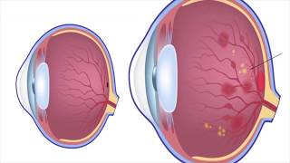 Patient experience post Diabetic Retinopathy Surgery