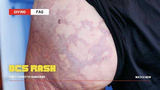 Decompression Sickness Rash