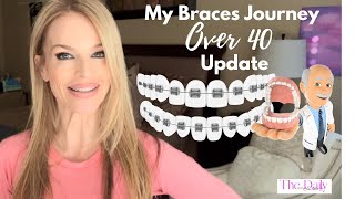 Braces Over 40 Journey UPDATE-What I Don't like About Braces and My Suggestions.