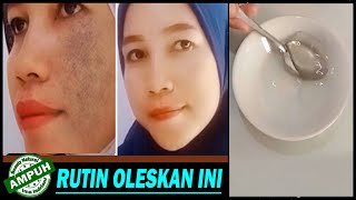 CARA MENGHILANGKAN FLEK HITAM  DENGAN CARA INI TERBUKTI 100% berhasil