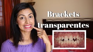 BRACKETS TRANSPARENTES, mi experiencia con la ortondoncia a los 30 | Mamá y maestra