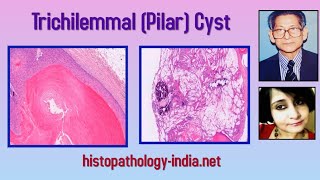 Pathology of Trichilemmal (Pilar) Cyst by Dr Sampurna Roy MD