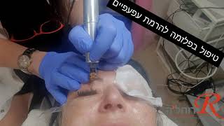 טיפול פלזמה להרמת עפעפיים אצל רוחל'ה קוסמטיקה בחיפה 052-2983263