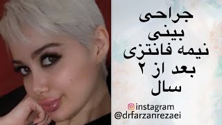 ‏‎نمونه ای از جراحی بینی نیمه فانتزی