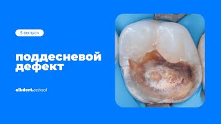 Поддесневые дефекты. Выпуск 5. aikdent.school