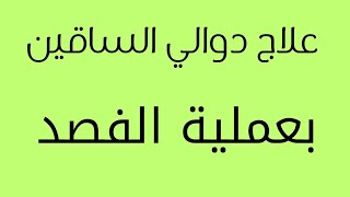 أسرع طريقة لعلاج دوالي الساقين هي الفصد : آمنة وسهلة ونتائج ممتازة