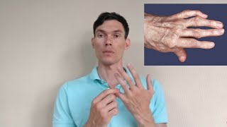 АРТРОЗ ПАЛЬЦЕВ РУК РАЗРАБОТКА arthrosis of the fingers