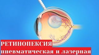 Ретинопексия   пневматическая и лазерная в лечении отслоения сетчатки глаза 👁️