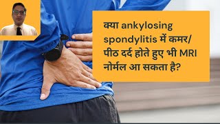 क्या ankylosing spondylitis में कमर/ पीठ दर्द होते हुए भी MRI नोर्मल आ सकता है?