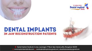 Dental Implants in Jaw Reconstruction Patients| Teeth Rehabilitation | Dental Implant Studio