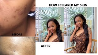 HOW I CLEARED MY ACNE USING ORATANE