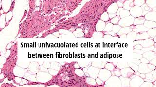 Pathology of Lipofibromatosis by Dr Sampurna Roy MD