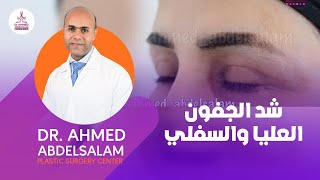 شد الجفن العلوي و السفلي..Upper & Lower Blepheroplasty