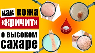 Предупреждающие признаки на коже, которые говорят о высоком уровне сахара в крови