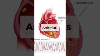 ARRITMIAS CARDÍACAS