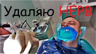 Удаляю НЕРВ!