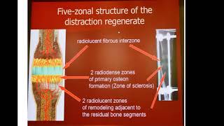 L10 fracture displacement , geometry and distraction osteogenesis by Dr ASM Abdullah