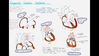 Congenital Heart Defects