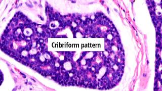 Pathology of Primary Cutaneous Adenoid Cystic Carcinoma by Dr Sampurna Roy MD