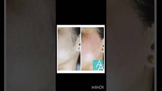 facial hair removal at home/Get Rid of Facial Hair#meriumpervaiz #facialhair#shortsfeed #viralvideo