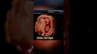 Siêu âm thai 14 tuần. Ở trong bụng bầu bé ngủ như nào nhỉ?#baby #shots