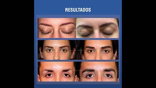 Injerto capilar en cejas | International Hair Clinic Ecuador