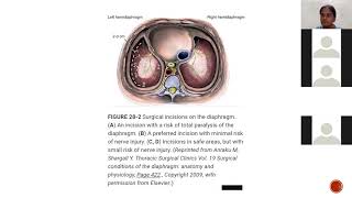 Seminar on MANAGEMENT OF DIAPHRAGMATIC HERNIA