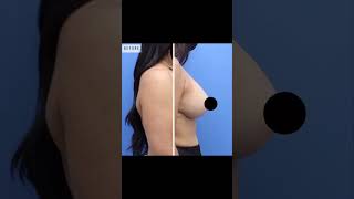 Elevate Your Confidence: Mastopexy with Augmentation by Dr. Altman