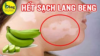 Tổng hợp những cách trị lang beng tại nhà cực kỳ đơn giản lại nhanh khỏi