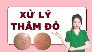 Cách Xử Lý Đúng Khi Bị Mụn Thâm Đỏ | Ngọc Nguyễn