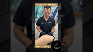 SCULPTRA - RADIESSE